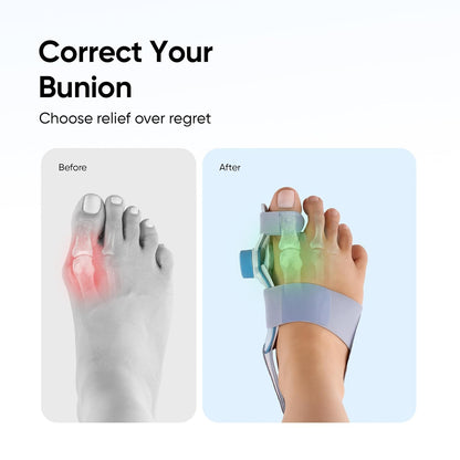 ComfortStep Daily Active Bunion Corrector